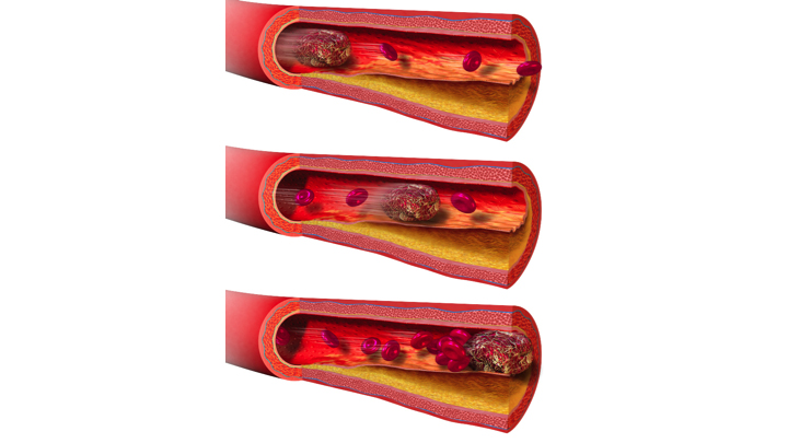 Stent mạch vành làm tăng nguy cơ xuất hiện nhồi máu cơ tim do cục máu đông.jpg